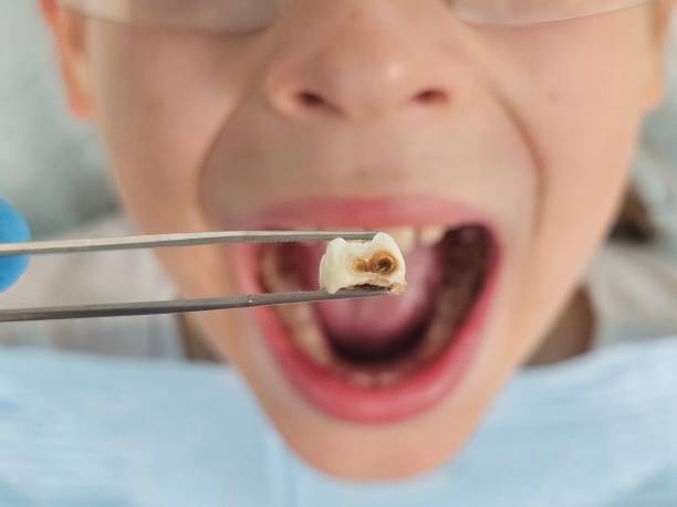 Best Emergency Dentist for Lost Fillings or Crowns in Riverbank, CA